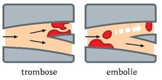trombose - embolie